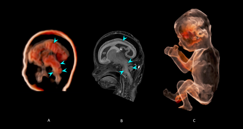 16 Weeks Gestation - 3D Human Development